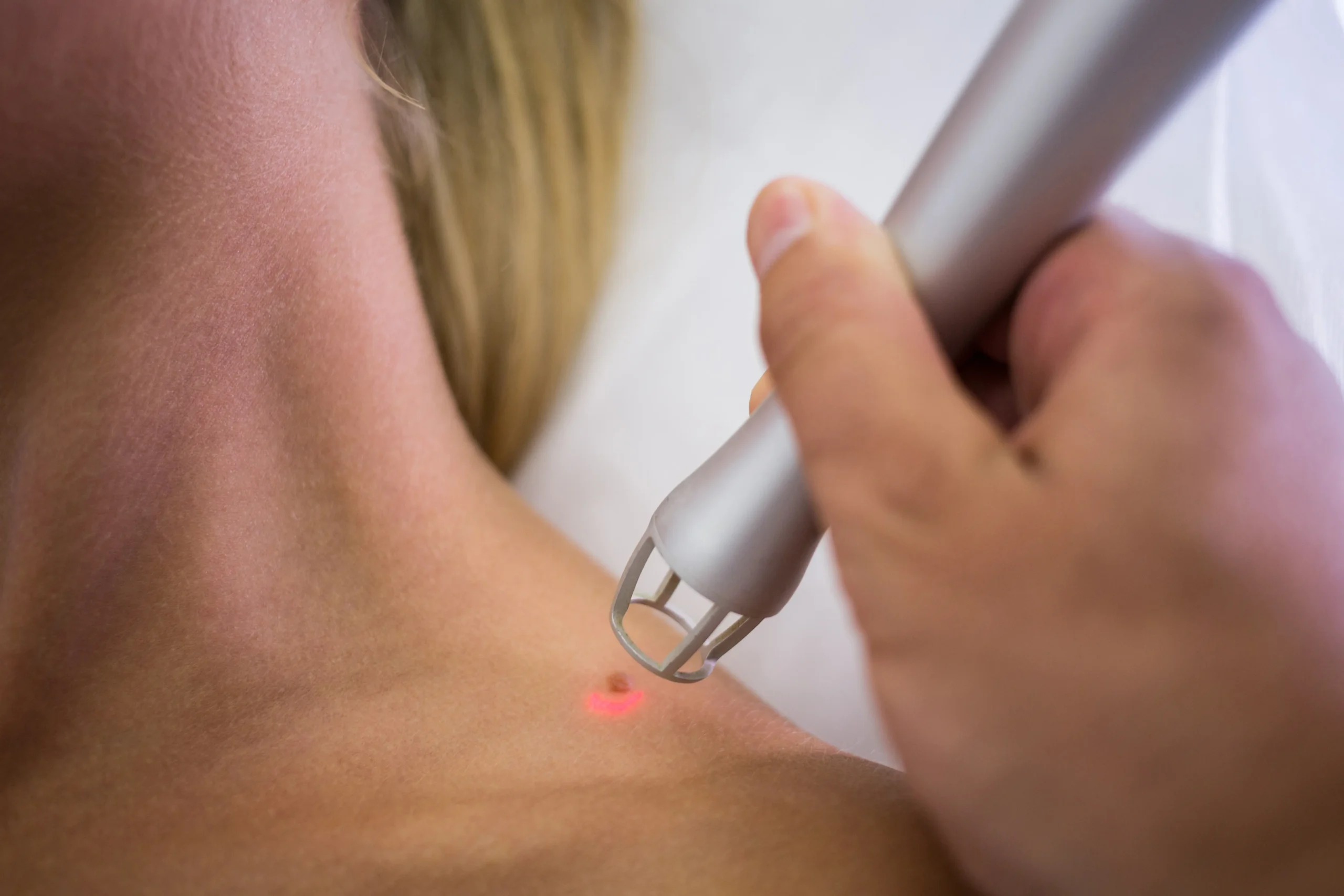 Laser Mole Removal Mumbai