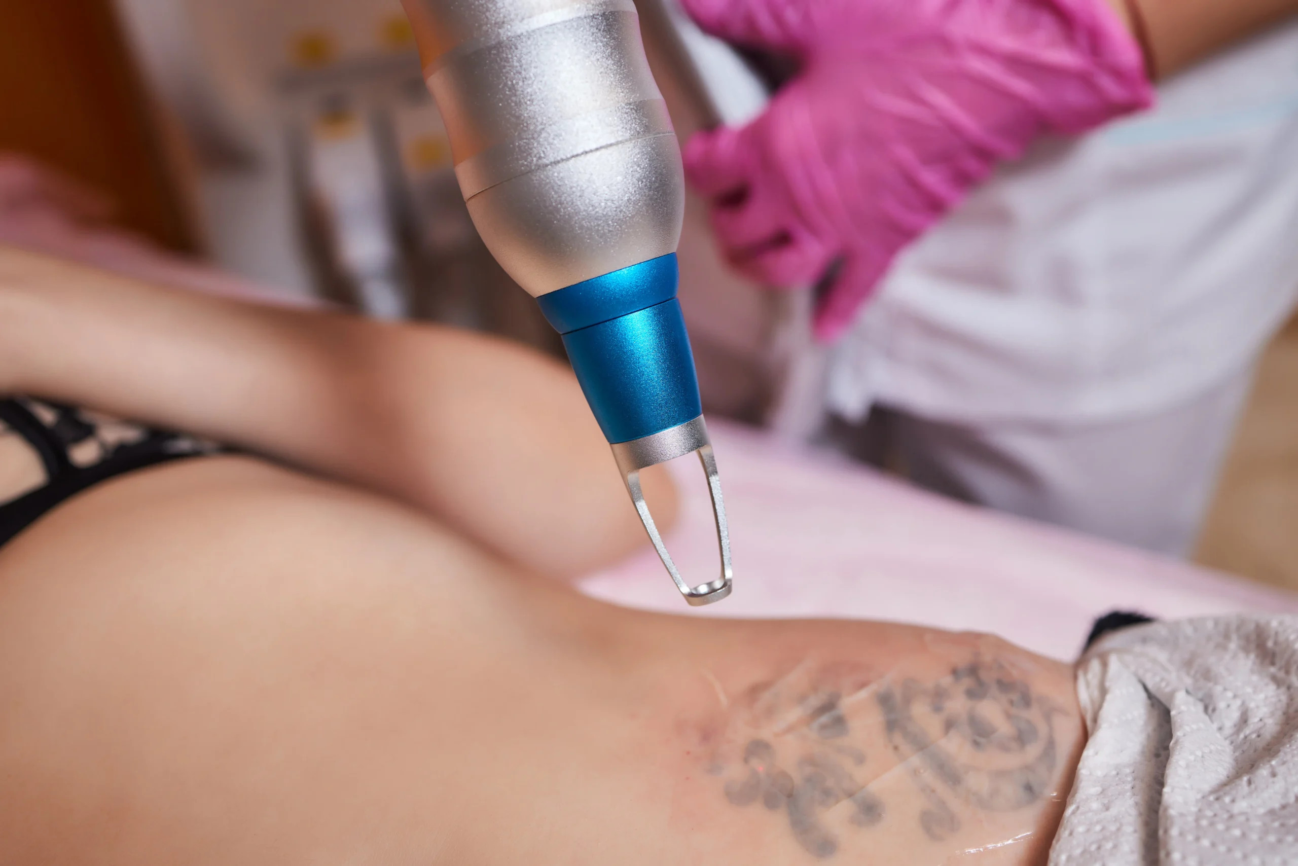 Laser Tattoo Removal Mumbai